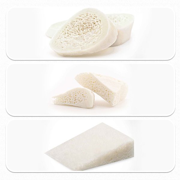 Wedge نوعی آلوگرفت استخوانی با فرم گوه‌ای‌شکل است که معمولاً از استخوان کورتیکوکَن‌سِلوس انسانی تهیه می‌شود.