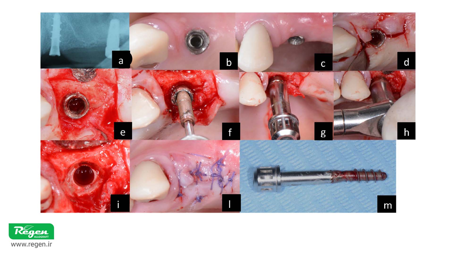 Dental Implant Removal