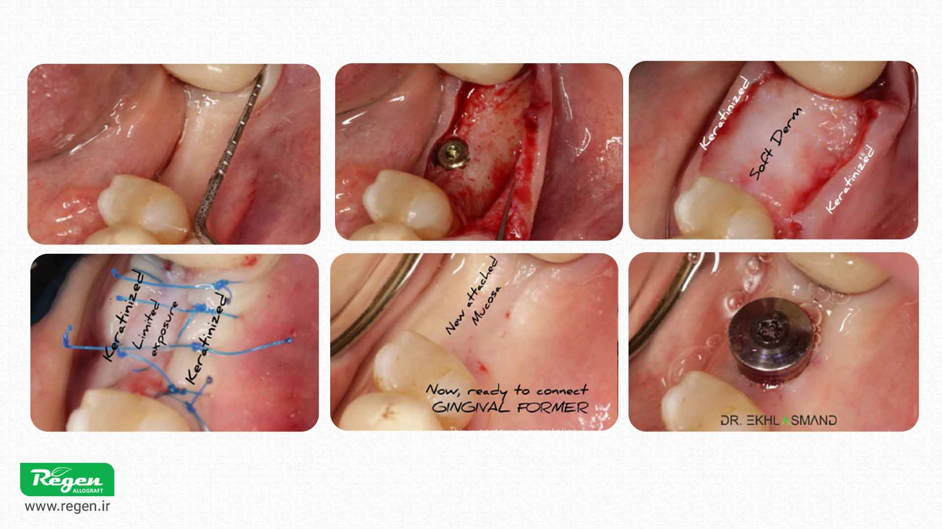 فلپ سافت درم