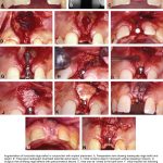 Augmentation of horizontal ridge defect in conjunction with implant placement