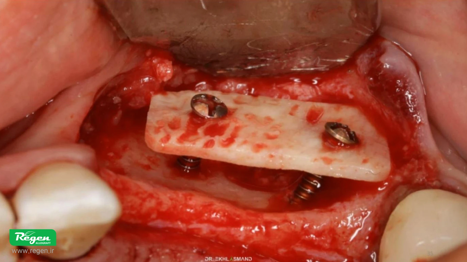 تکنیک ریج اسپلیت ساخته‌شده است و گزینه ایده‌آلی برای تکنیک‌های گسترش استخوان است.