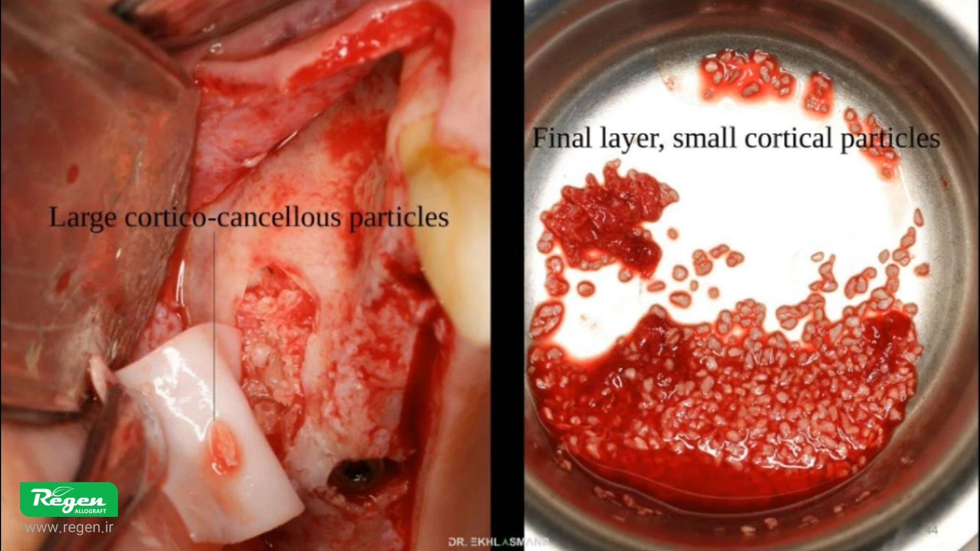 پودر استخوان کنسلوس Cortical bone powder