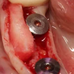 ممبرین دندانپزشکی کلاژنی Acellular Dermis Soft Derm