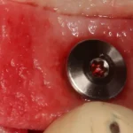 کاربرد محصول سافت درم در جراحی پریودنتولوژی