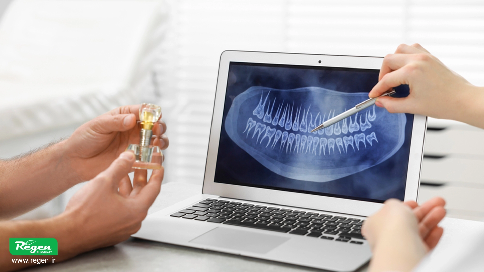 خارج کردن ایمپلنت 