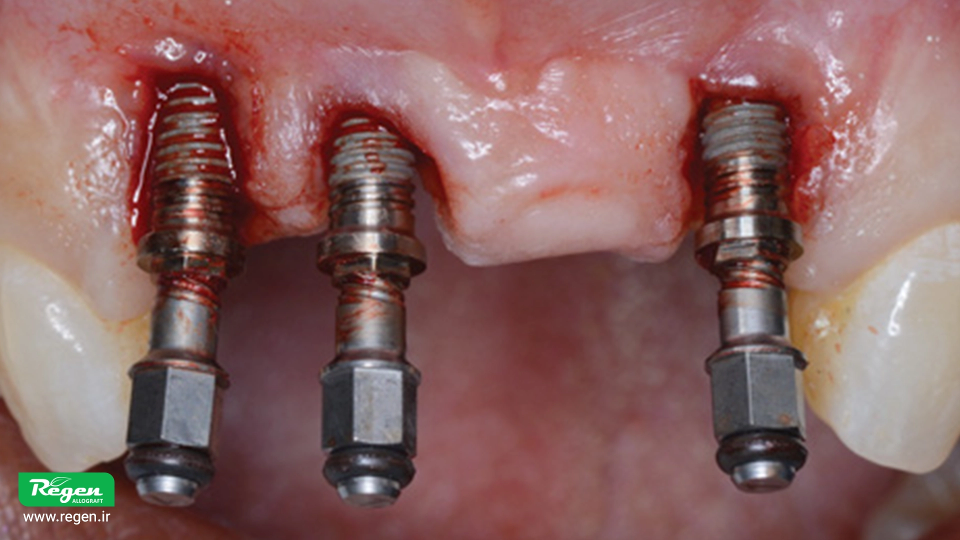 خارج کردن ایمپلنت