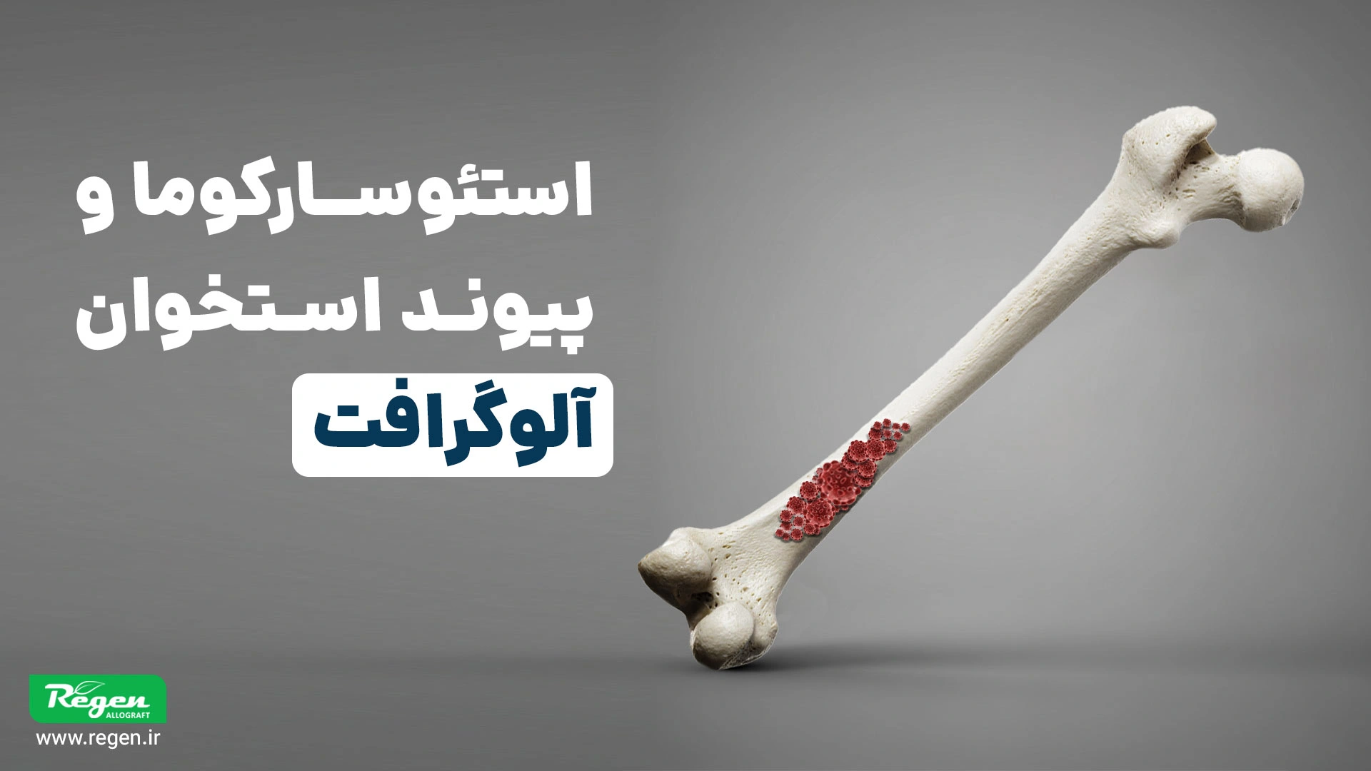 تصویر سهبعدی استخوان ران با ناحیه قرمز نشاندهنده استئوسارکوما؛ همراه با عنوان استئوسارکوما و پیوند استخوان آلوگرافت