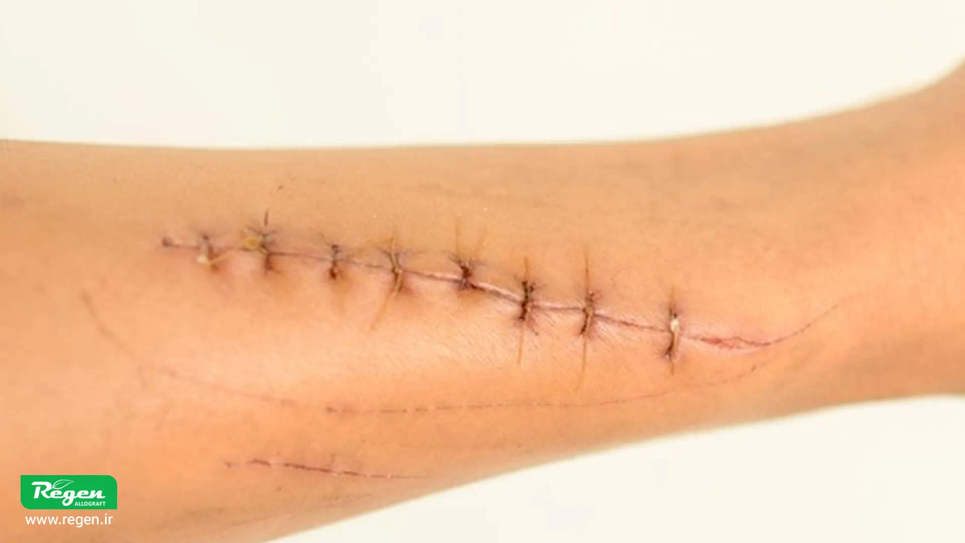 Elimination of Donor-Site Factors in Autografts