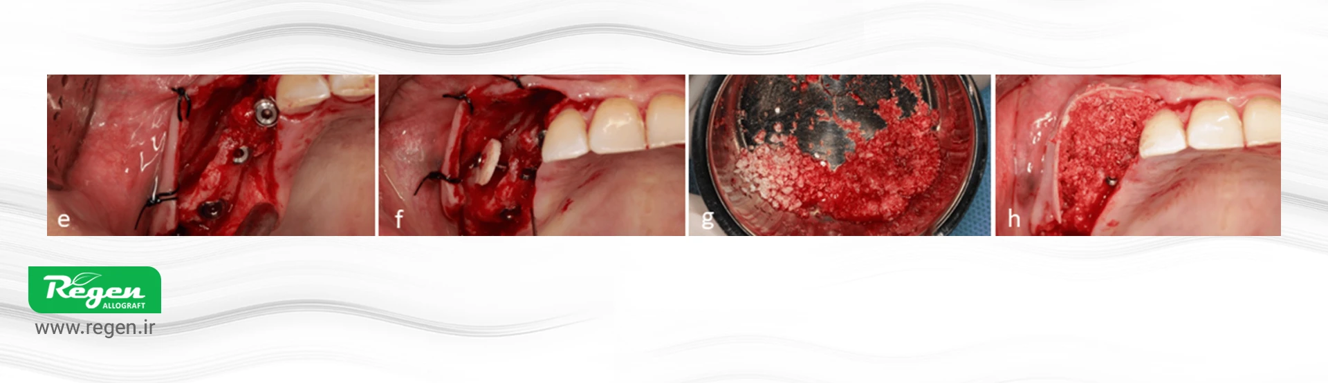 انتخاب ماده پیوندی در فضای زیر دیسک کورتیکال با استفاده از آلوگرافت کورتیکال خالص و Bone Conditioned Medium (BCM)
