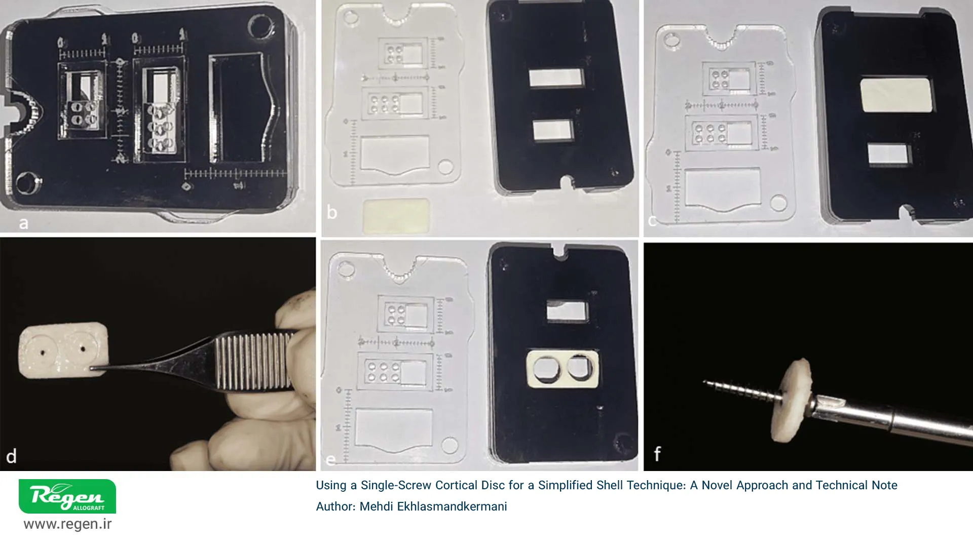 آمادهسازی و فیکساسیون دیسک کورتیکال تکپیچ در تکنیک شِل با استفاده از قالب اختصاصی Regen Allograft