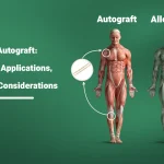 Allograft or Autograft: Advantages, Applications, and Clinical Considerations