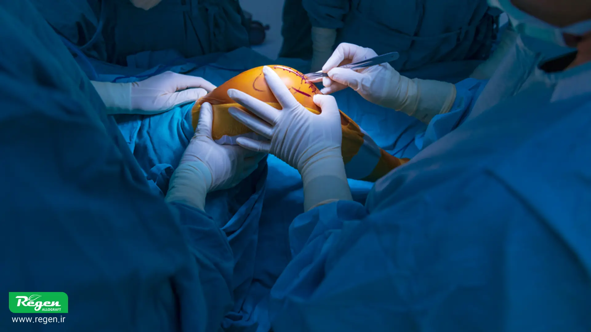 جراحی پارگی تاندون زانو