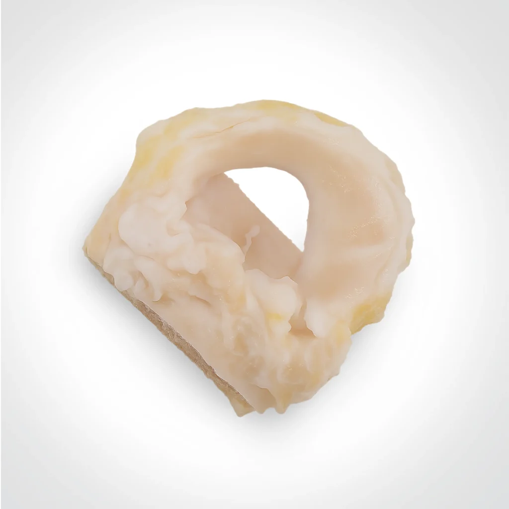 Meniscus Allograft یک بافت پیوندی انسانی با کیفیت بالا است که از منیسک طبیعی زانو تهیه و تحت فرآوری، پاکسازی و استریلیزاسیون استاندارد آمادهسازی میشود. این گرافت در جراحیهای ارتوپدی برای بازسازی منیسک، جایگزینی منیسک آسیبدیده، حفظ پایداری زانو و جلوگیری از تخریب مفصلی مورد استفاده قرار میگیرد.