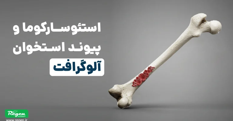تصویر سه‌بعدی استخوان ران با ناحیه قرمز نشان‌دهنده استئوسارکوما؛ همراه با عنوان استئوسارکوما و پیوند استخوان آلوگرافت