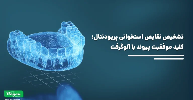 تشخیص نقایص استخوانی پریودنتال؛ کلید موفقیت پیوند با آلوگرفت